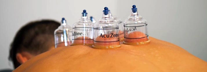 Cupping therapy being performed on a patient's back