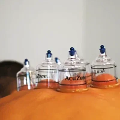 A patient receiving cupping therapy